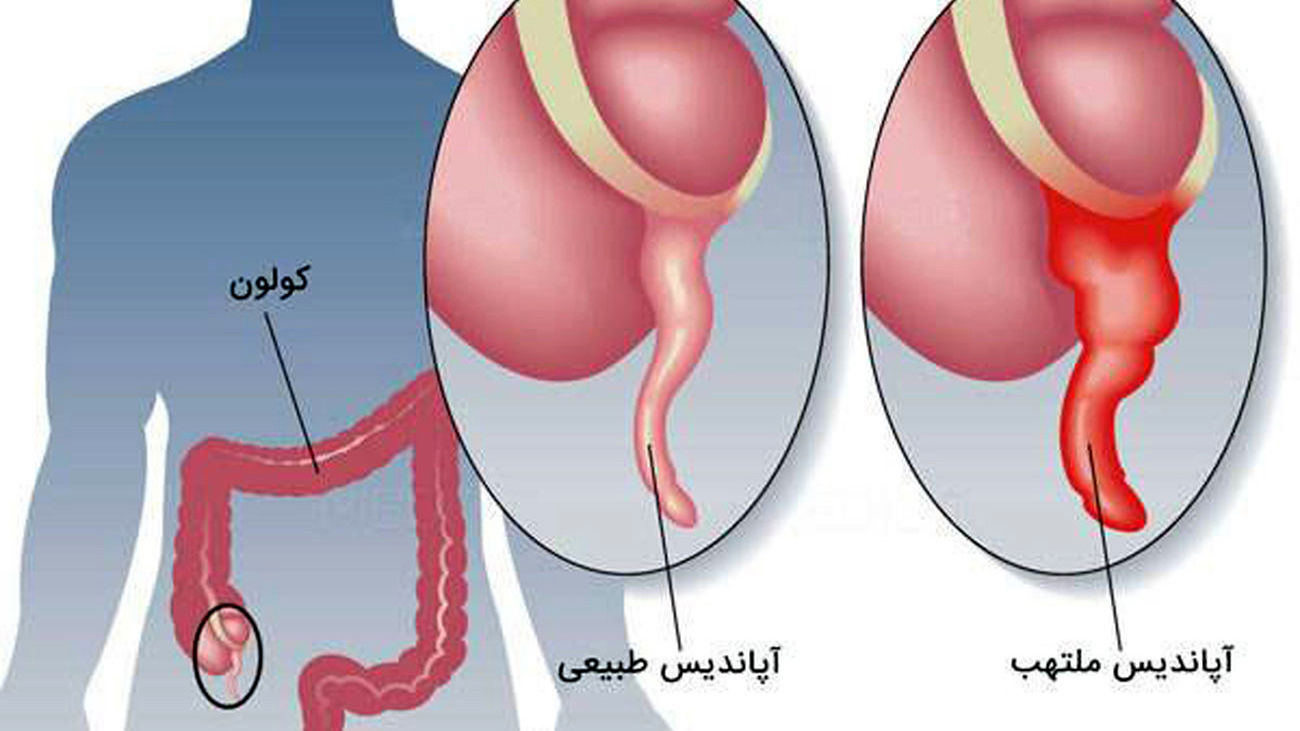 عمل جراحی آپاندیسیت - بیمارستان بین المللی و فوق تخصصی حکیم